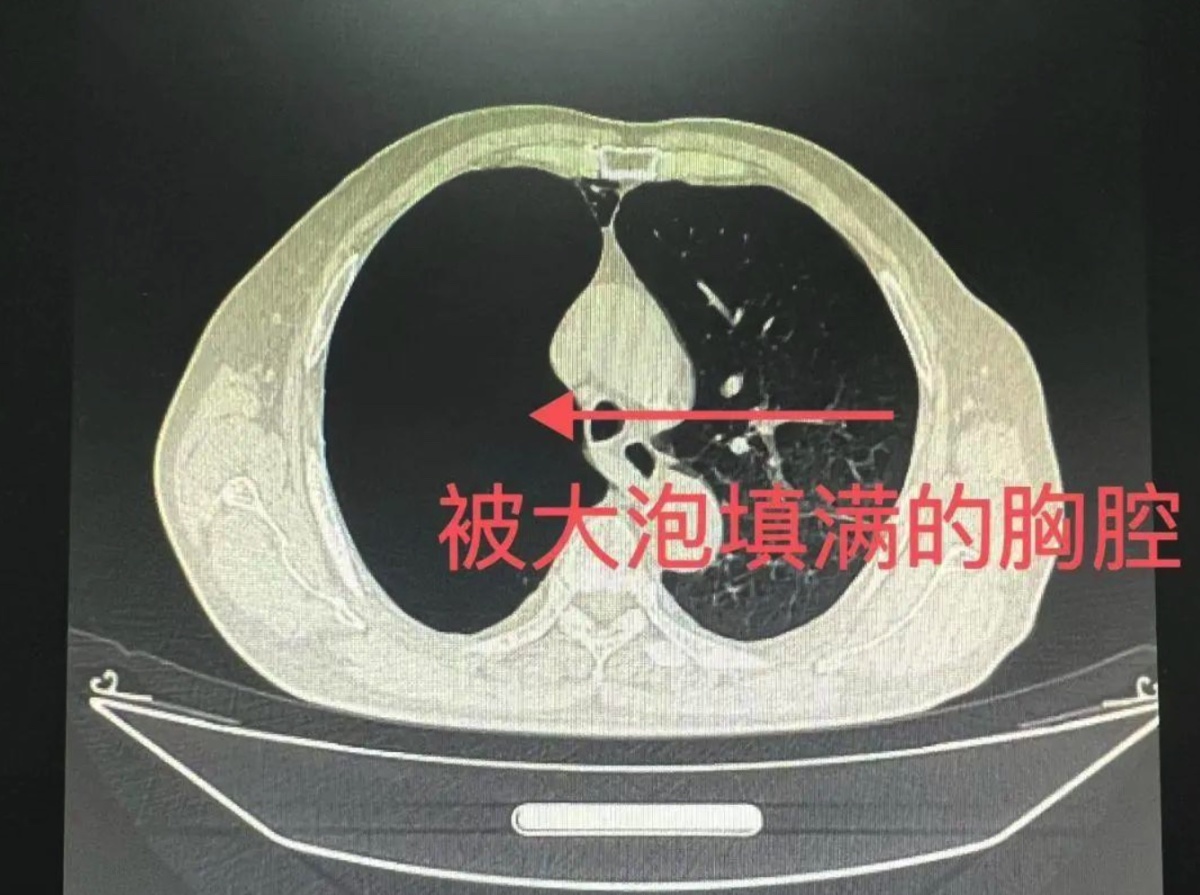 肺不张x线表现图片,肺结核x线胸片图解(2) - 伤感说说吧